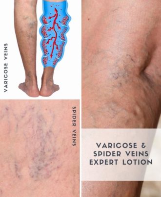 Advanced Varicose Veins Lotion Spider Veins & Restless Legs Illustration
