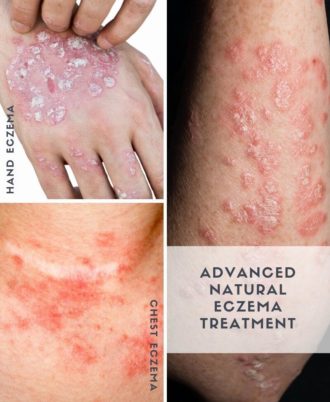 Relief & Repair Expert Natural Eczema Lotion Illustration