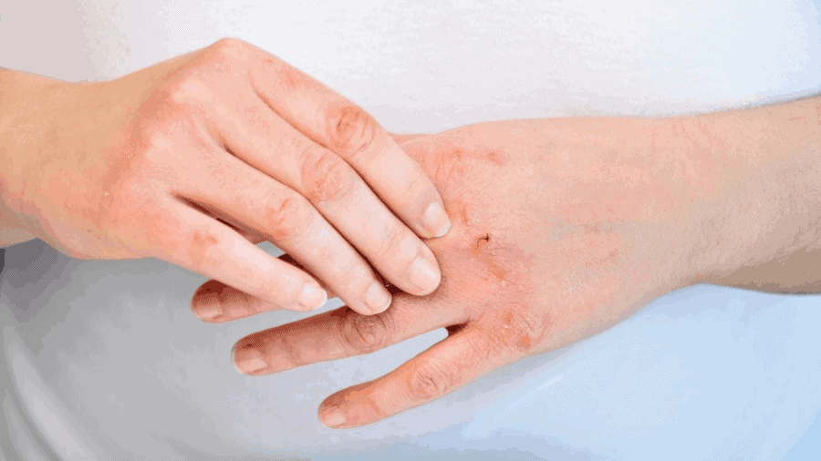 Eczema Advanced Natural treatment by Dr. Elix