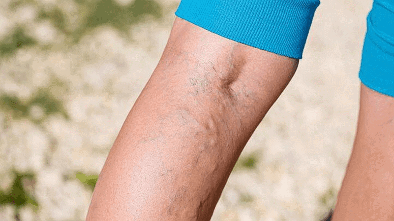 Varicose veins & Spider veins Natural treatment by Dr. Elix