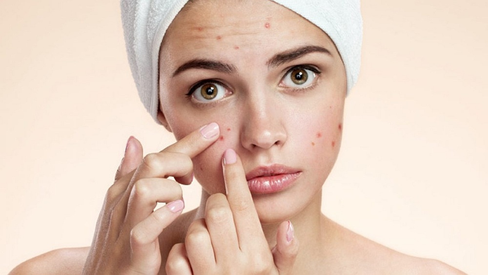 Acne treatment - Dr Elix best natural remedies Online store