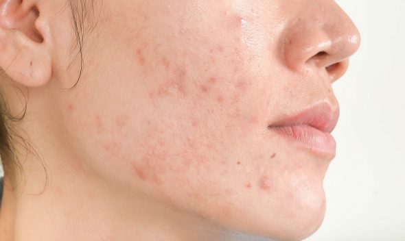 Acne causes, best acne treatment and tips by Dr Elix
