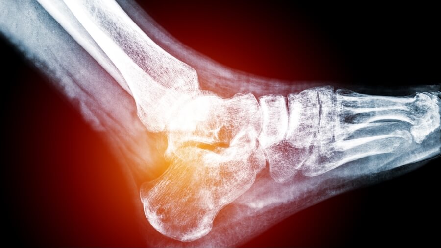 Gout in Heel causes, signs and treatment by Dr. Elix