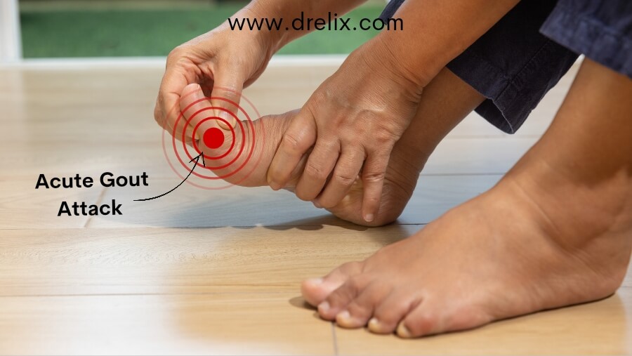 How to get rid of gout pain fast - Dr Elix